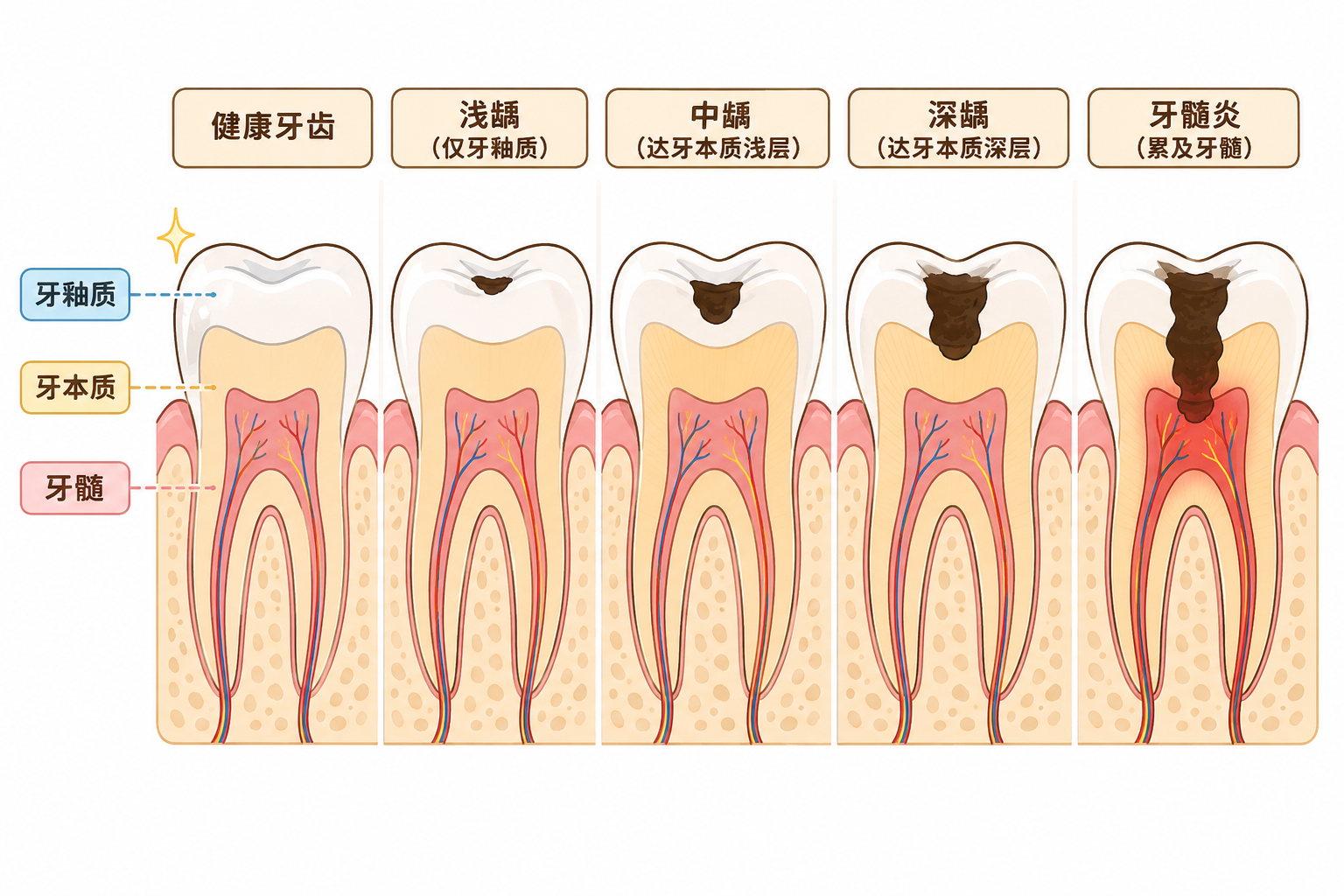 \\"牙齿结构分层与蛀牙深度的关系\\" \\"牙齿结构分层与蛀牙深度的关系\\"